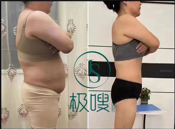 极嗖减肥加盟